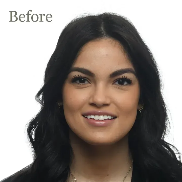 Teeth-Alignment-d4e1c2e6-1000h